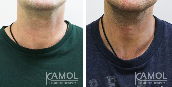Cirurgia de Masculinização Facial / FMS 9 lg 6494959932ce7 image