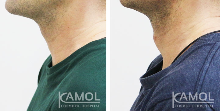 Cirurgia de Masculinização Facial / FMS 10 lg 649495993499b image