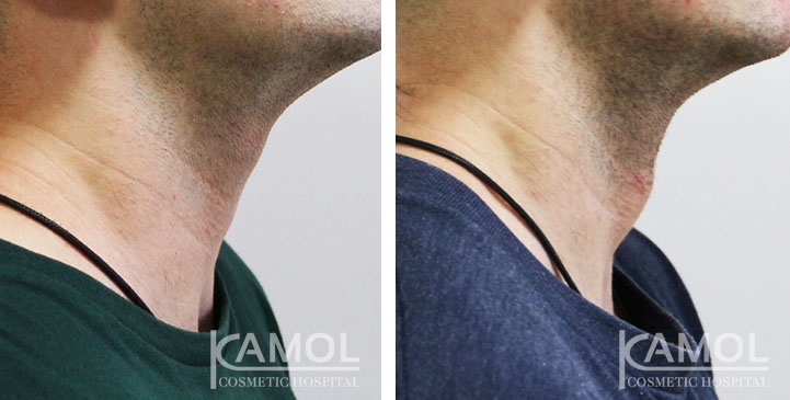 Cirurgia de Masculinização Facial / FMS 11 lg 649495993678e image