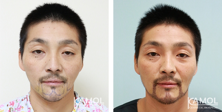 Cirurgia de Masculinização Facial / FMS 13 lg 649495993902a image