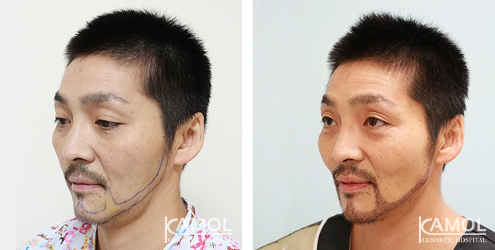 Cirurgia de Masculinização Facial / FMS 16 lg 649495993af26 image