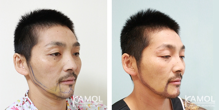 Cirurgia de Masculinização Facial / FMS 15 lg 649495993cf9a image