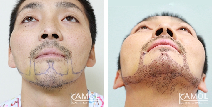Cirurgia de Masculinização Facial / FMS 14 lg 649495993ed25 image