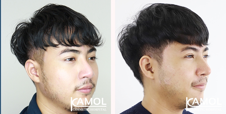 Cirurgia de Masculinização Facial / FMS 19 lg 64949599425e4 image