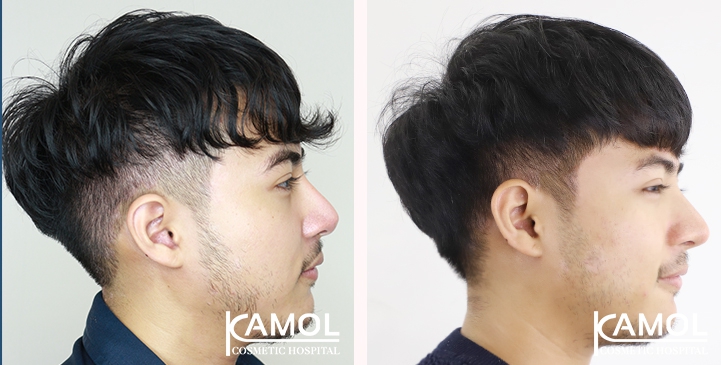 Cirurgia de Masculinização Facial / FMS 20 lg 6494959943cf4 image