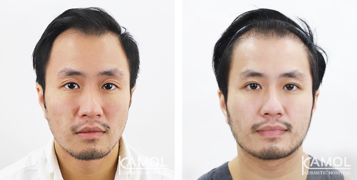 Cirurgia de Masculinização Facial / FMS 22 lg 64949599467c1 image