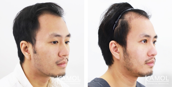 Cirurgia de Masculinização Facial / FMS 23 lg 649495994880d image