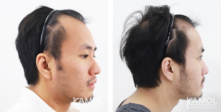 Cirurgia de Masculinização Facial / FMS 27 lg 649495994a67f image