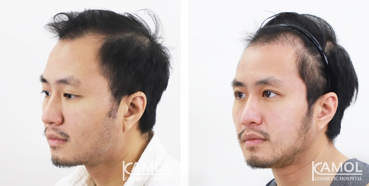 Cirurgia de Masculinização Facial / FMS 26 lg 649495994c65f image