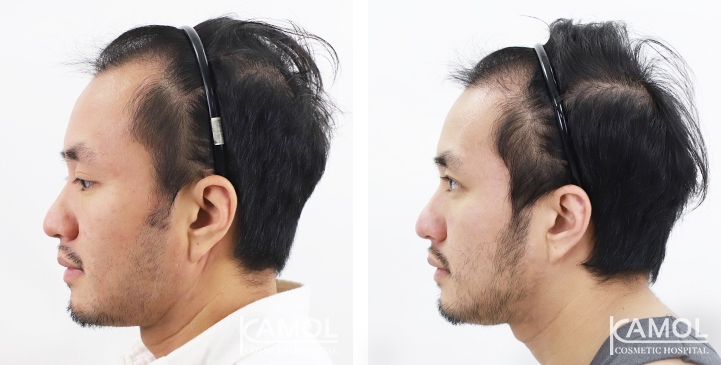 Cirurgia de Masculinização Facial / FMS 25 lg 649495994e2f8 image