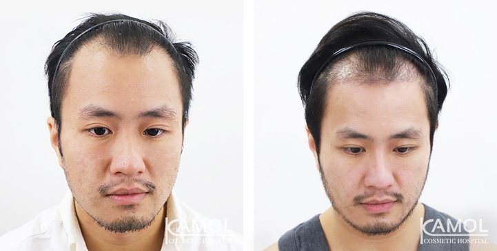 Cirurgia de Masculinização Facial / FMS 24 lg 64949599500a5 image