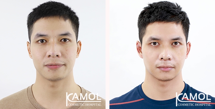Cirurgia de Masculinização Facial / FMS 29 lg 6494959952c7e image