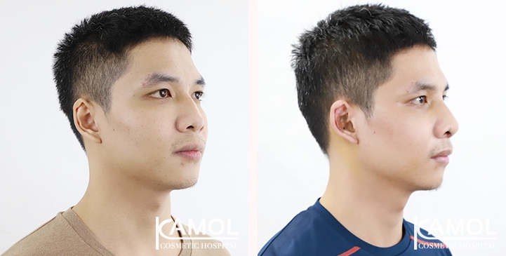 Cirurgia de Masculinização Facial / FMS 32 lg 6494959954986 image