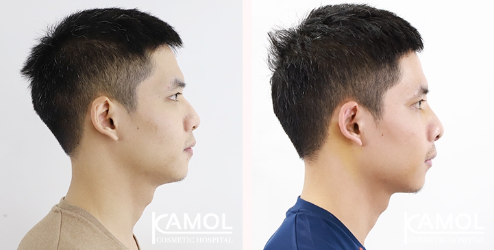 Cirurgia de Masculinização Facial / FMS 31 lg 6494959956955 image