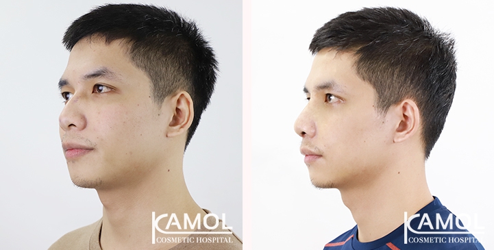 Cirurgia de Masculinização Facial / FMS 30 lg 6494959958709 image