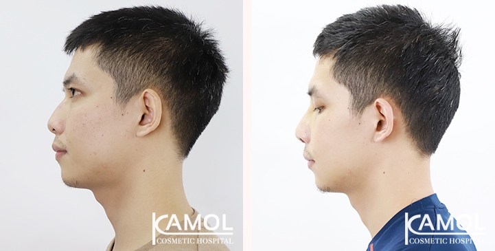 Cirurgia de Masculinização Facial / FMS 33 lg 649495995a577 image
