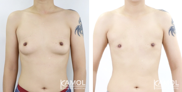 Chirurgie du Torse / Mastectomie 2 lg 64949599602a6 image