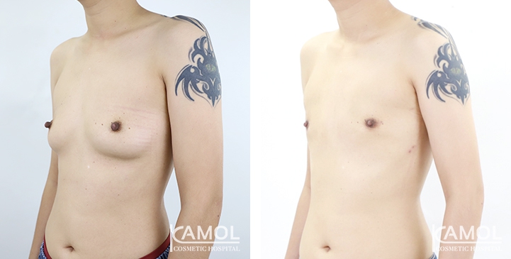 Chirurgie du Torse / Mastectomie 3 lg 6494959962192 image