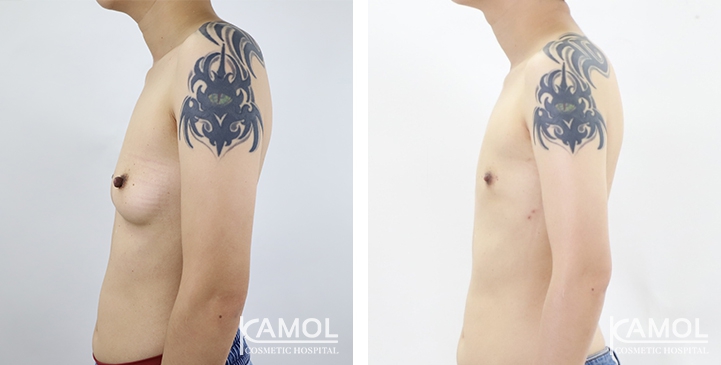 Chirurgie du Torse / Mastectomie 4 lg 64949599641e6 image