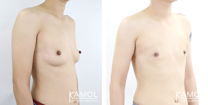 Chirurgie du Torse / Mastectomie 5 lg 6494959965e8d image