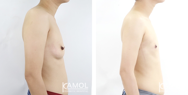 Chirurgie du Torse / Mastectomie 6 lg 6494959967d75 image