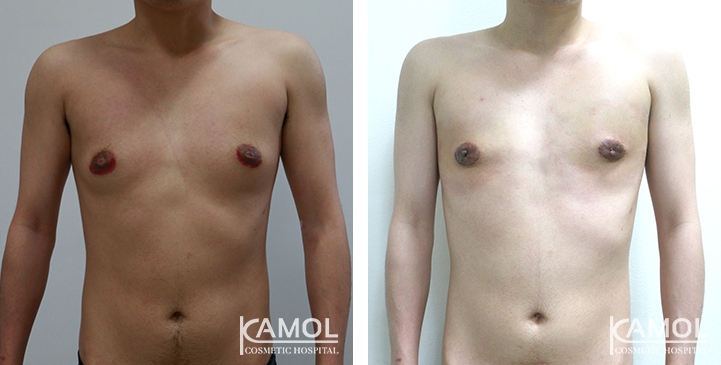 Chirurgie du Torse / Mastectomie 8 lg 649495996a929 image