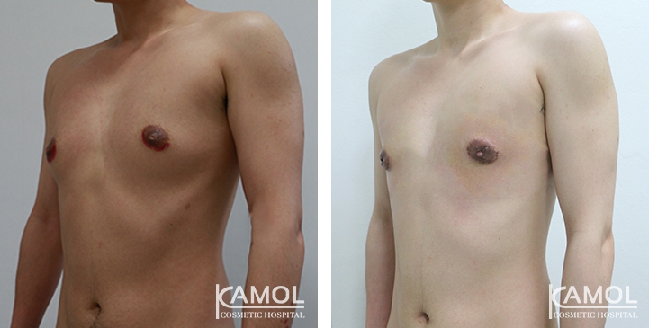 Chirurgie du Torse / Mastectomie 9 lg 649495996ce1a image