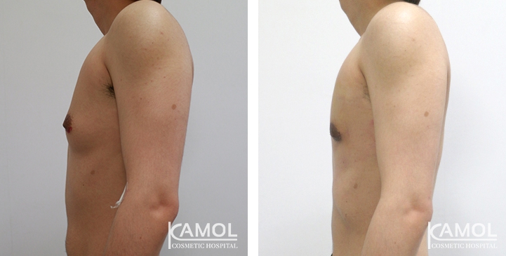 Chirurgie du Torse / Mastectomie 10 lg 649495996f052 image