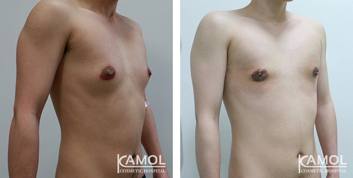 Chirurgie du Torse / Mastectomie 11 lg 649495997127f image