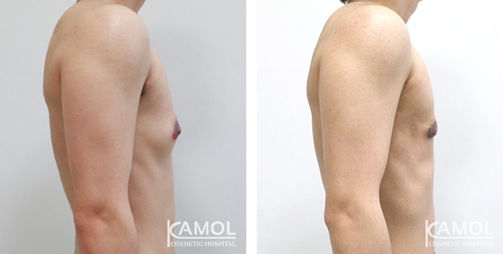 Chirurgie du Torse / Mastectomie 12 lg 6494959973589 image
