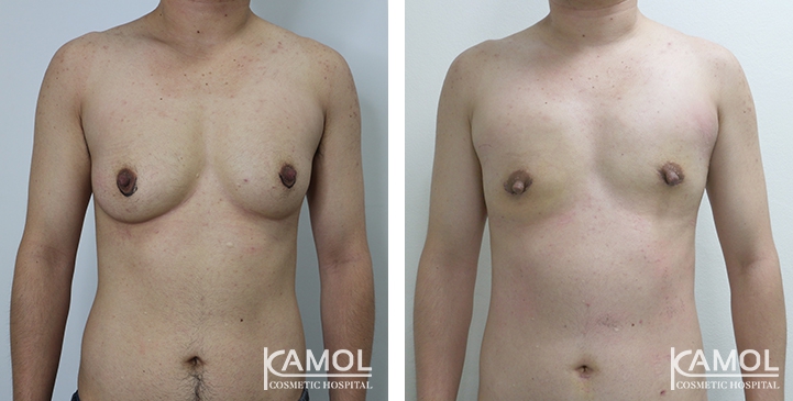 Chirurgie du Torse / Mastectomie 14 lg 649495997652a image