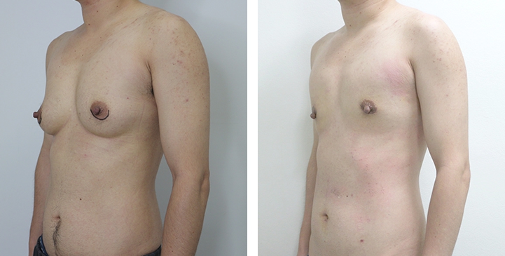 Chirurgie du Torse / Mastectomie 15 lg 6494959978898 image