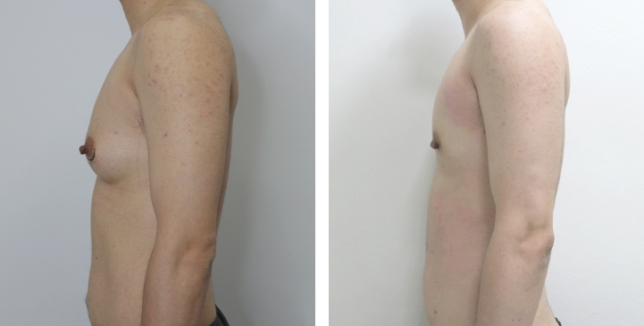 Chirurgie du Torse / Mastectomie 16 lg 649495997a9d7 image