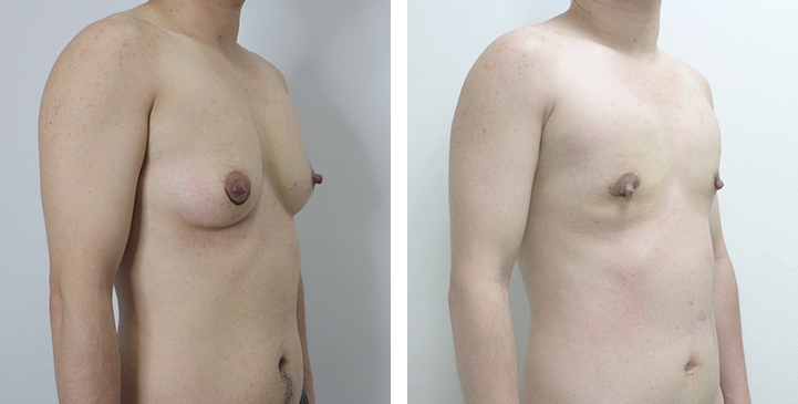Chirurgie du Torse / Mastectomie 17 lg 649495997ca49 image