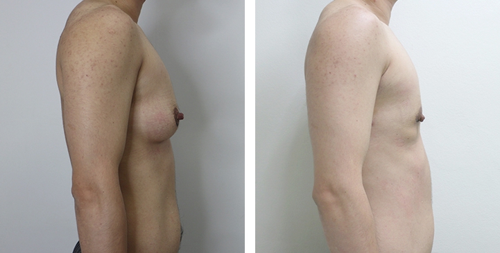 Chirurgie du Torse / Mastectomie 18 lg 649495997e911 image