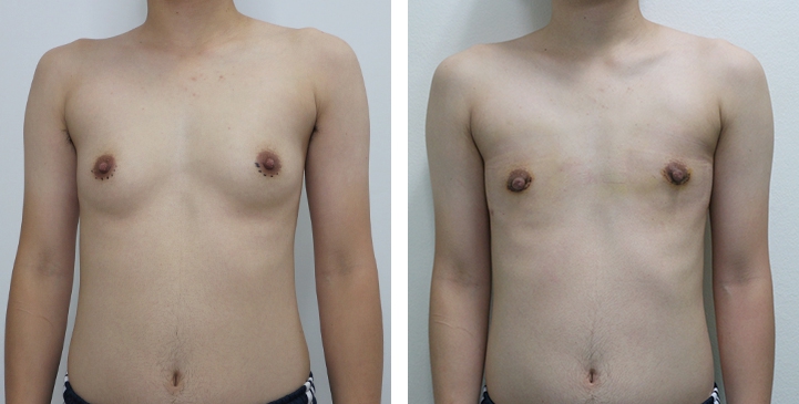 Chirurgie du Torse / Mastectomie 20 lg 64949599813e6 image