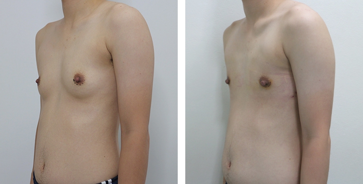 Chirurgie du Torse / Mastectomie 21 lg 64949599833ab image