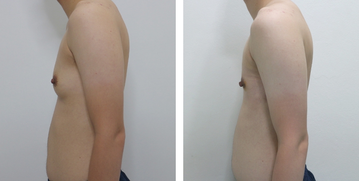 Chirurgie du Torse / Mastectomie 23 lg 6494959985179 image