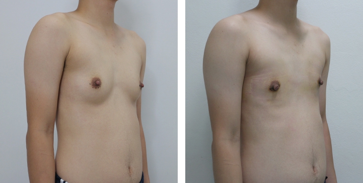 Chirurgie du Torse / Mastectomie 22 lg 6494959987232 image