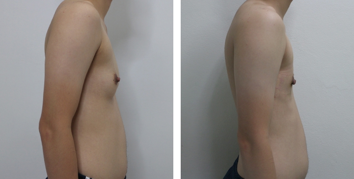 Chirurgie du Torse / Mastectomie 24 lg 649495998927a image