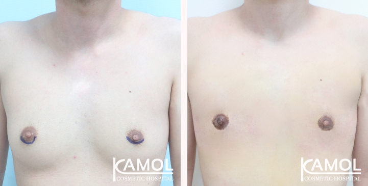 Chirurgie du Torse / Mastectomie 30 lg 649495998be19 image