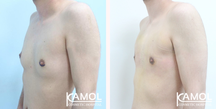 Chirurgie du Torse / Mastectomie 29 lg 649495998dd38 image