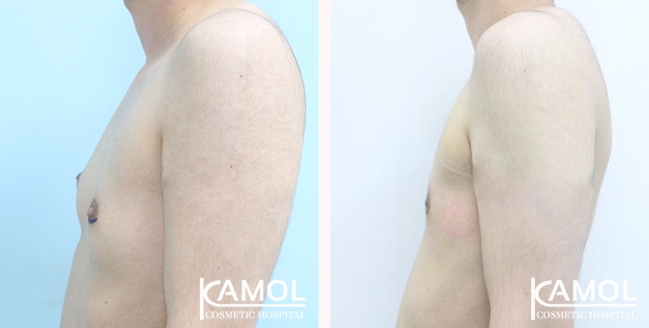 Chirurgie du Torse / Mastectomie 28 lg 649495998fb4c image