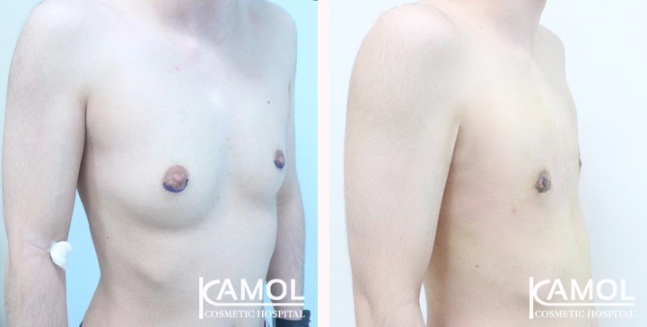 Chirurgie du Torse / Mastectomie 27 lg 6494959991942 image