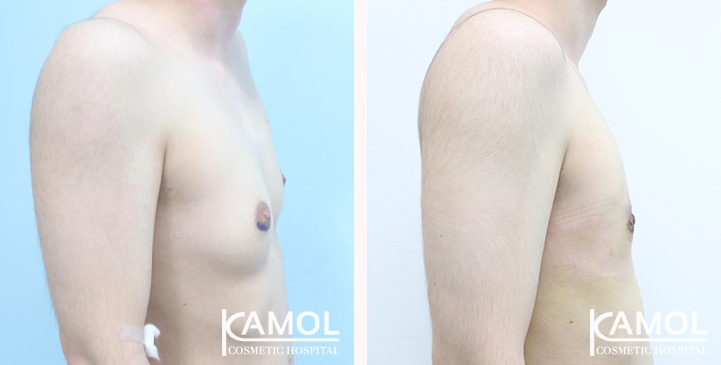 Chirurgie du Torse / Mastectomie 26 lg 6494959993805 image