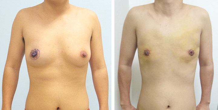 Chirurgie du Torse / Mastectomie 32 lg 6494959996222 image