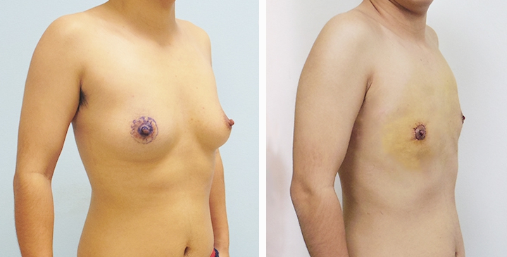 Chirurgie du Torse / Mastectomie 33 lg 649495999837b image