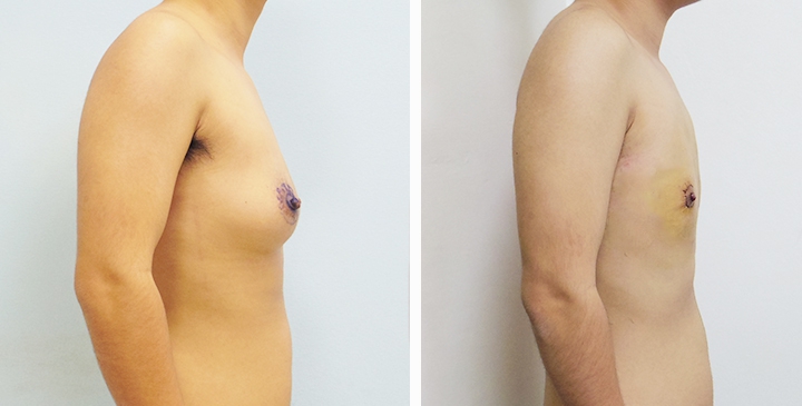 Chirurgie du Torse / Mastectomie 34 lg 649495999a25a image