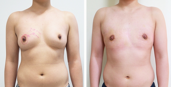 Chirurgie du Torse / Mastectomie 36 lg 649495999cdd9 image
