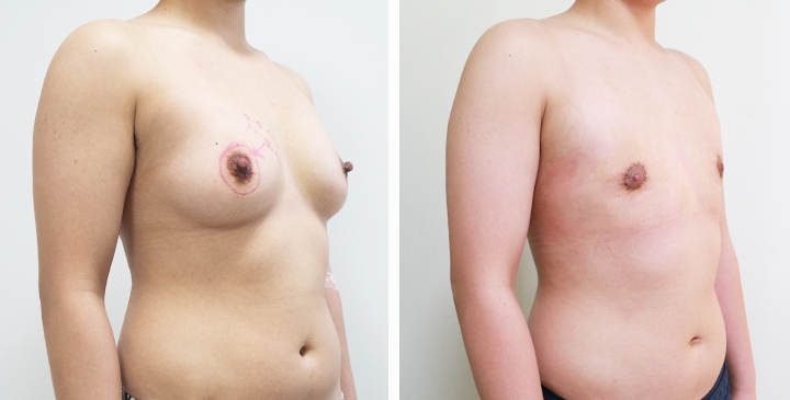 Chirurgie du Torse / Mastectomie 38 lg 64949599a0717 image